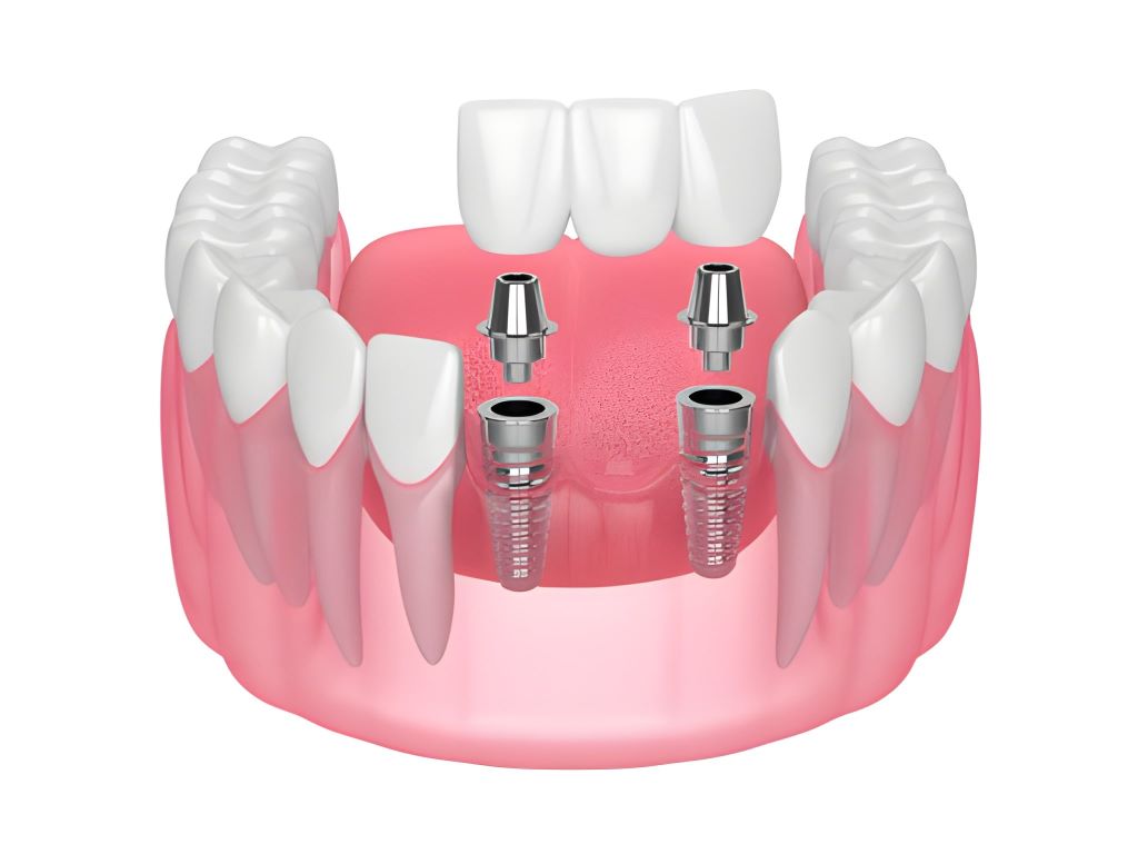 dental crowns near you