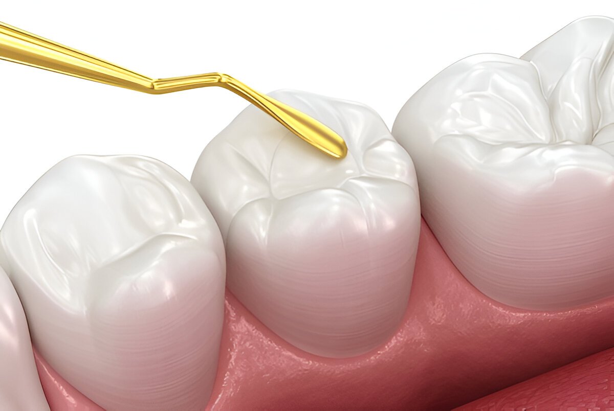 dental fillings near you​