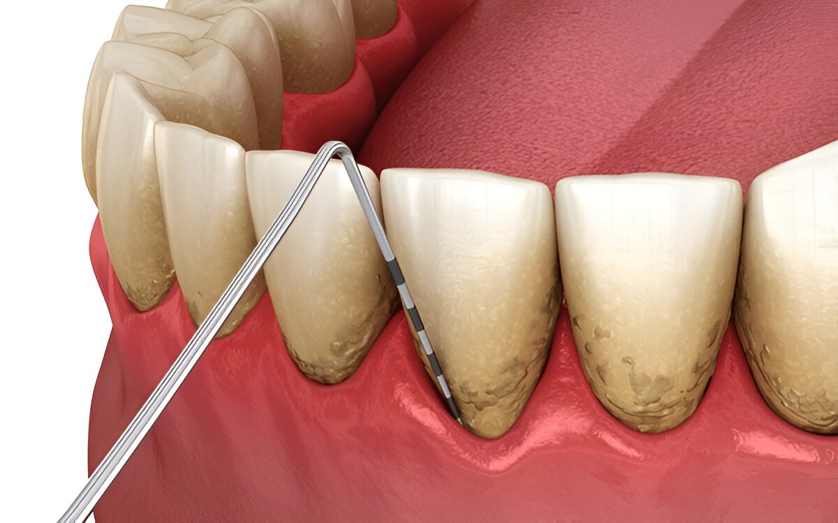 periodontal disease treatment near you