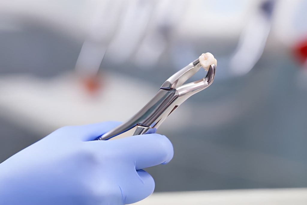 tooth extractions in londonderry