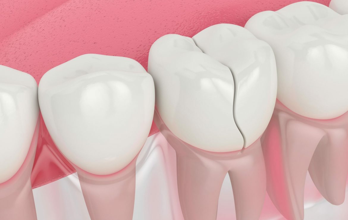 chipped or fractured teeth repair in londonderry