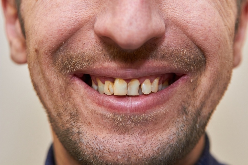 chipped or fractured teeth repair near you