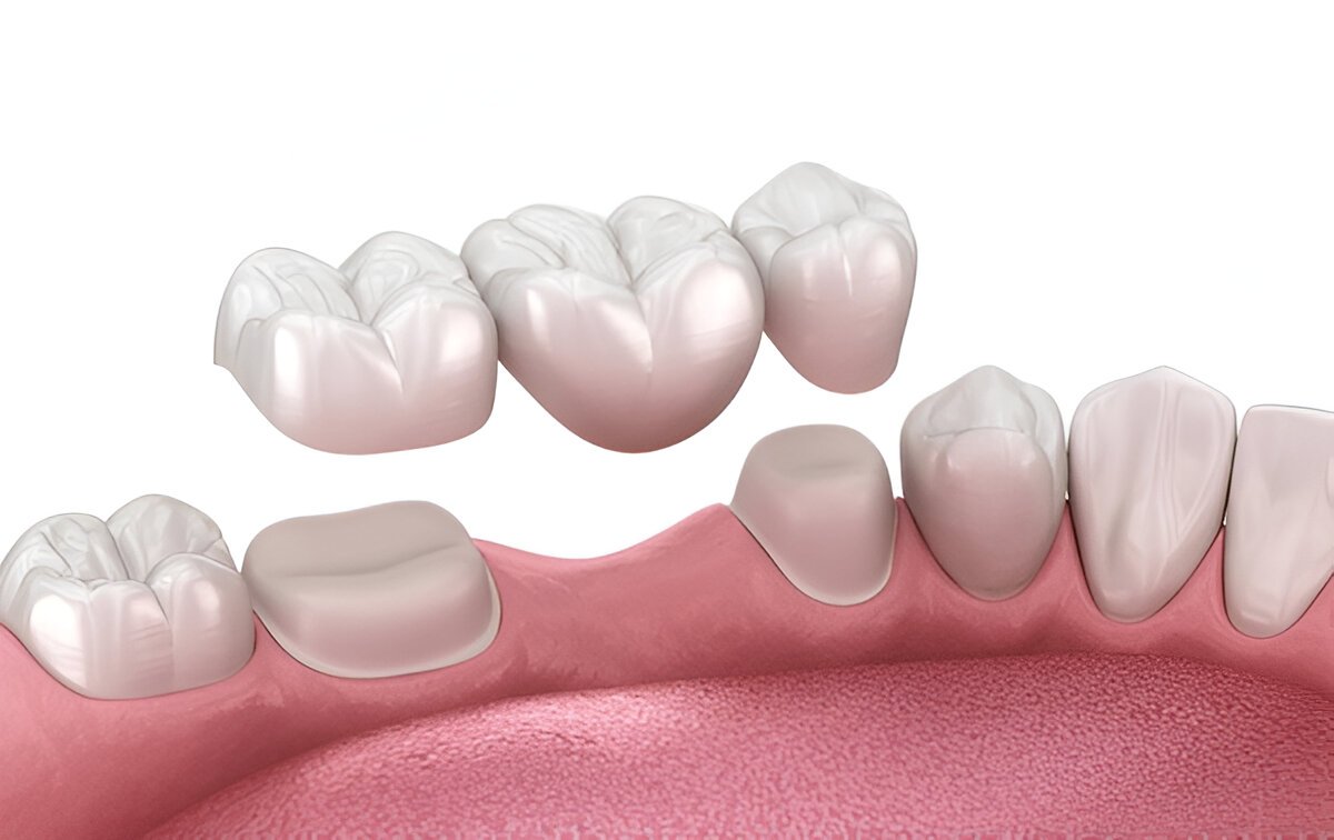 dental bridges in londonderry