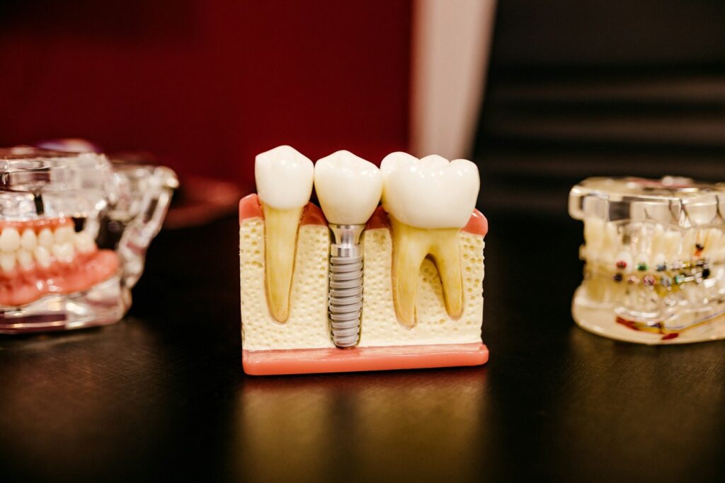 dental implant service in londonderry