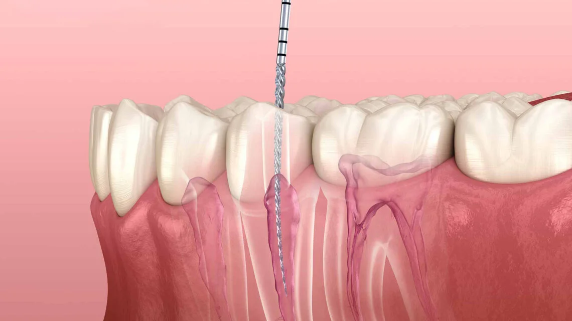 emergency root canal in londonderry