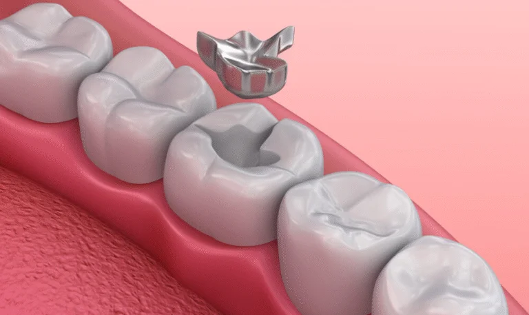 lost or loose fillings & crowns in londonderry