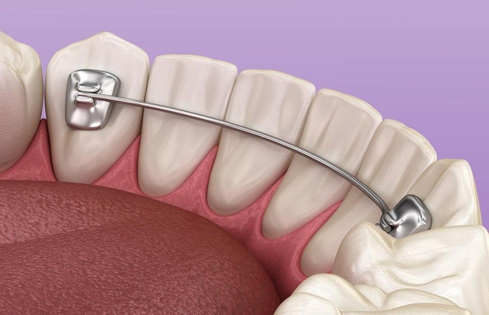 orthodontic retainers in londonderry