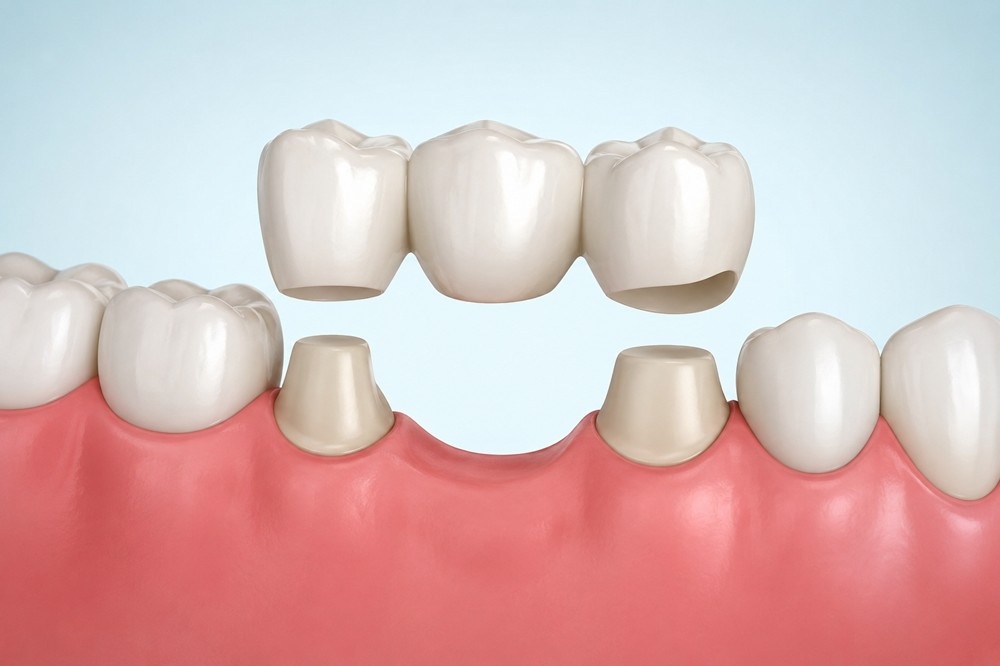 Enhance Your Smile: How Modern Dental Bridges Work